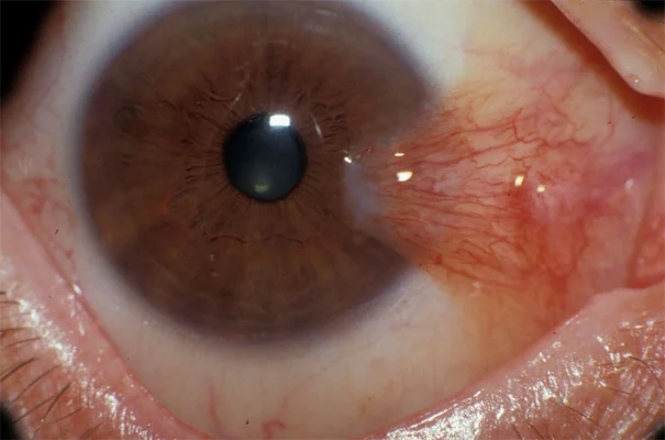 Pterygium Surgery