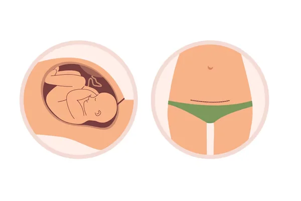 Caesarean Section Delivery